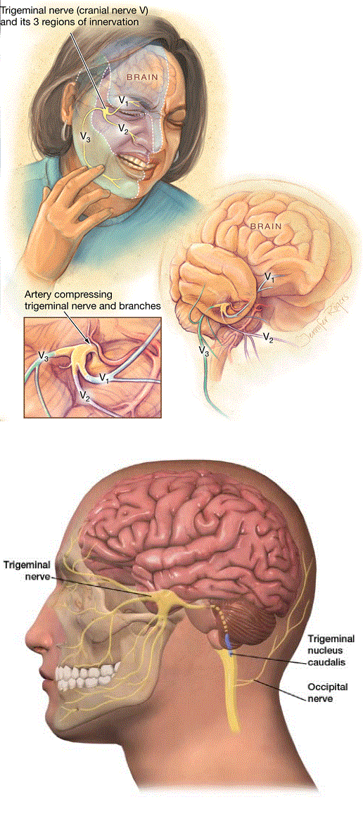 Trigeminal-neuralgia-explanation.gif