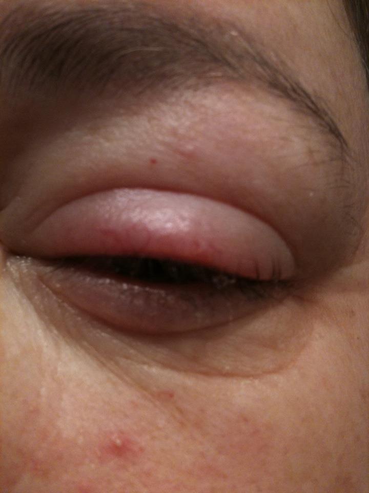 edema.jpg